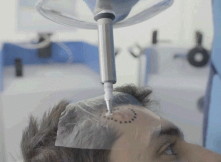 Innovative Non-Surgical Skin Cancer Treatment Offered At The London Clinic